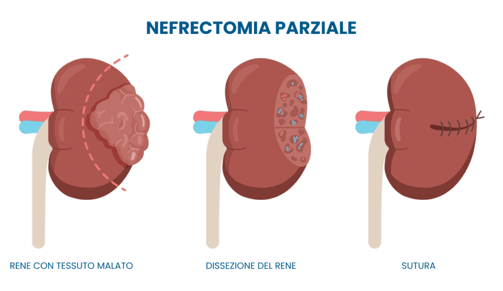 Nefrectomia parziale vs totale 