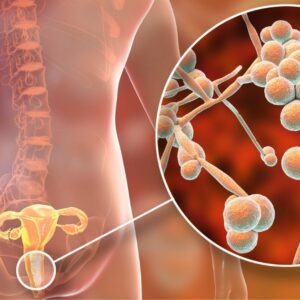 Candida overgrowth from a functional medicine perspective