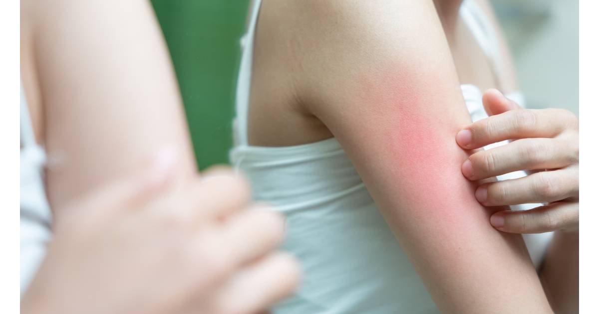 skin irritation as a result of yeast infections