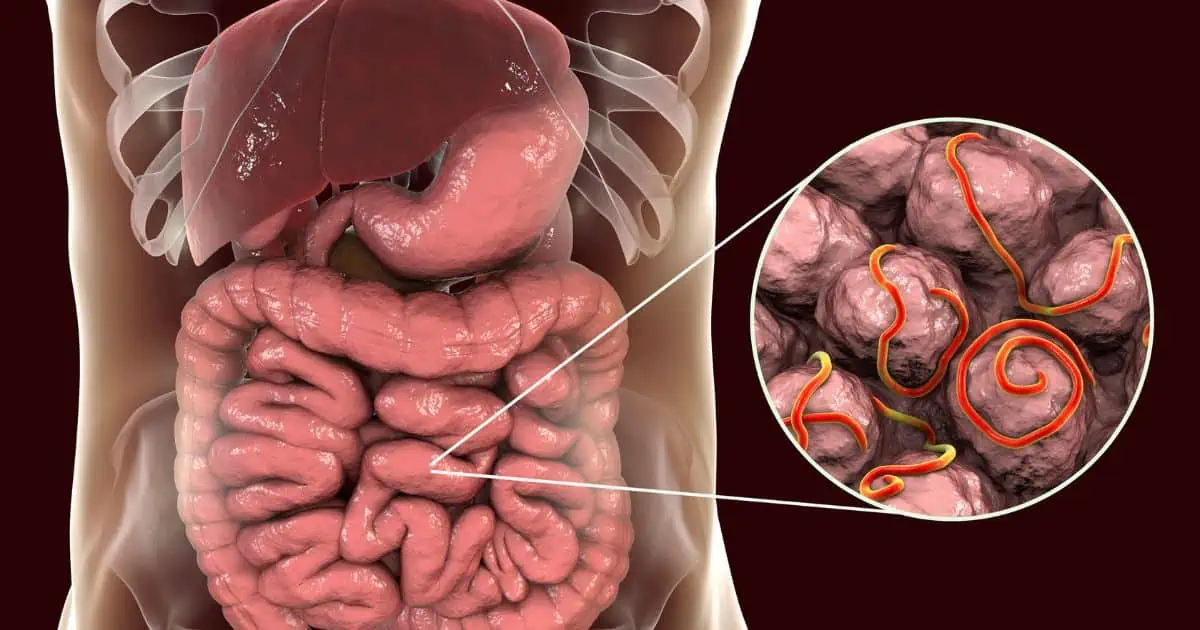 Gut infections causing IBS and Adrenal Fatigue