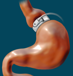 gastric band around stomach