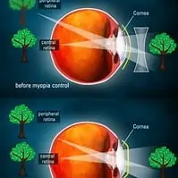 Otho K myopia control method