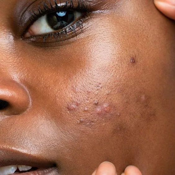Acne breakout from whey protein