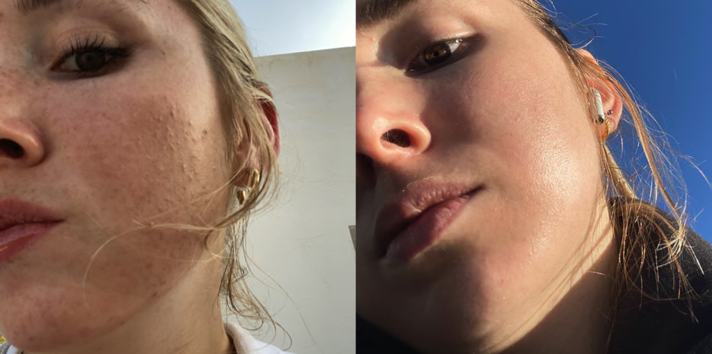 Before and after using retinaldehyde