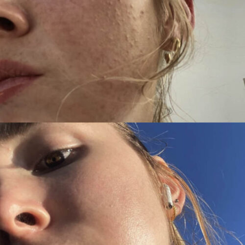Clogged pores before and after