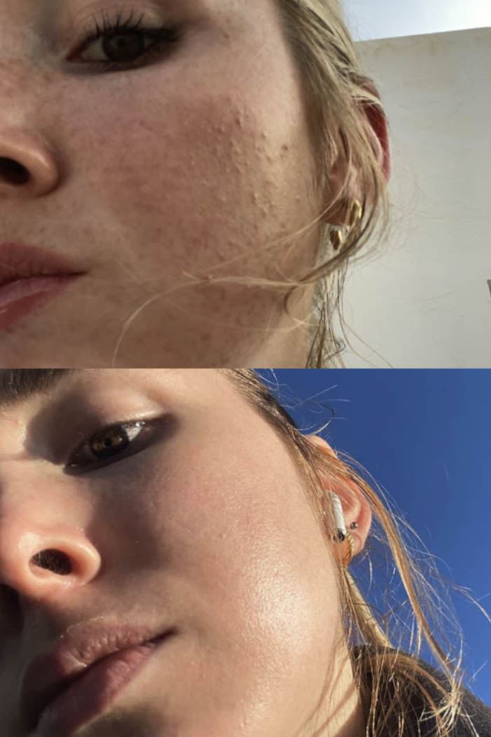 How to Get Rid of Clogged Pores (and Four Mistakes to Avoid!)