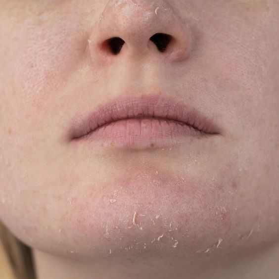 Side effects of the cerave salicylic acid cleanser includes dryness and skin flaking