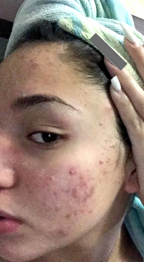 Cerave SA cleanser purge