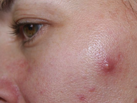 Best Korean Moisturizers for Acne-Prone Skin, especially cystic acne