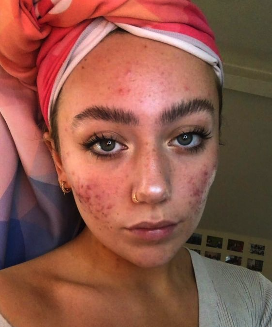The best moisturisers for acne prone skin