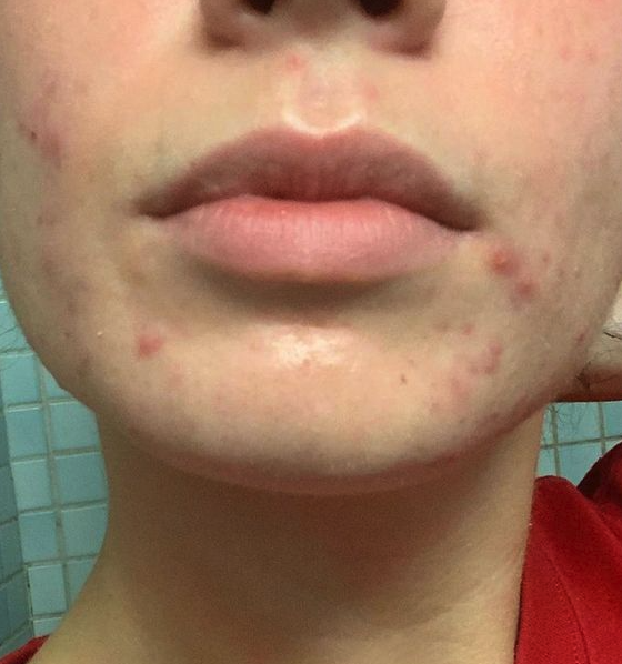 Can IBS cause hormonal acne?
