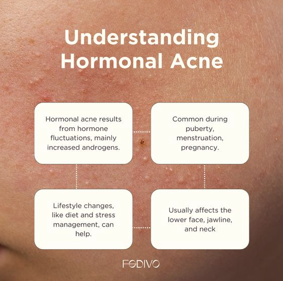 Can silk pillowcases help reduce hormonal acne