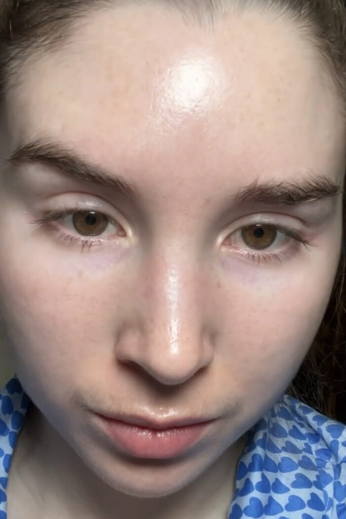 Explaining The Viral Sebaceous Filament Hack