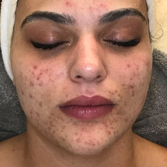 Cleansers for acne-prone skin