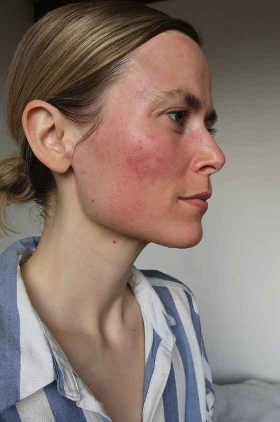 Why Does Skin Burn When Applying Moisturizer or Lotion?