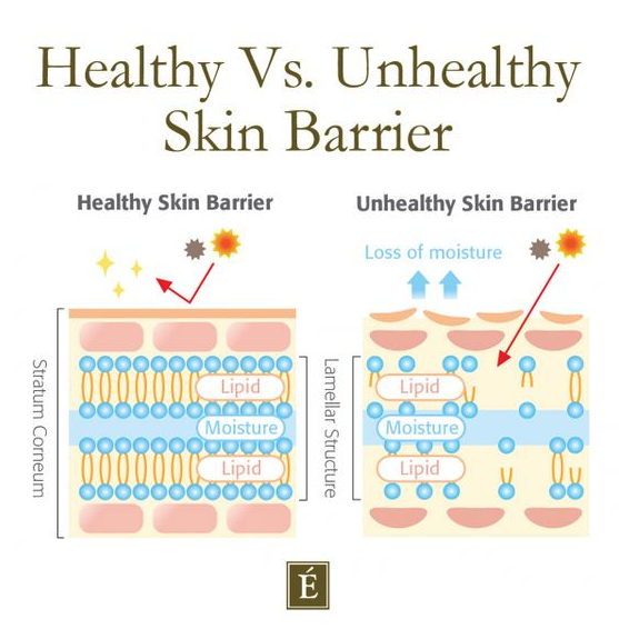 Damaged skin barrier causes skin burns when applying moisturiser