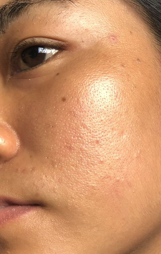 Signs you have a damaged skin barrier