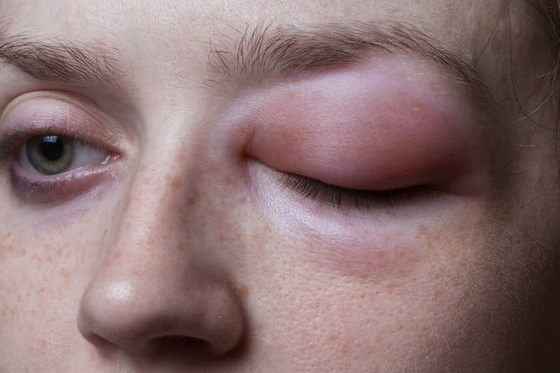 Can an allergic reaction cause skin burning after lotion?