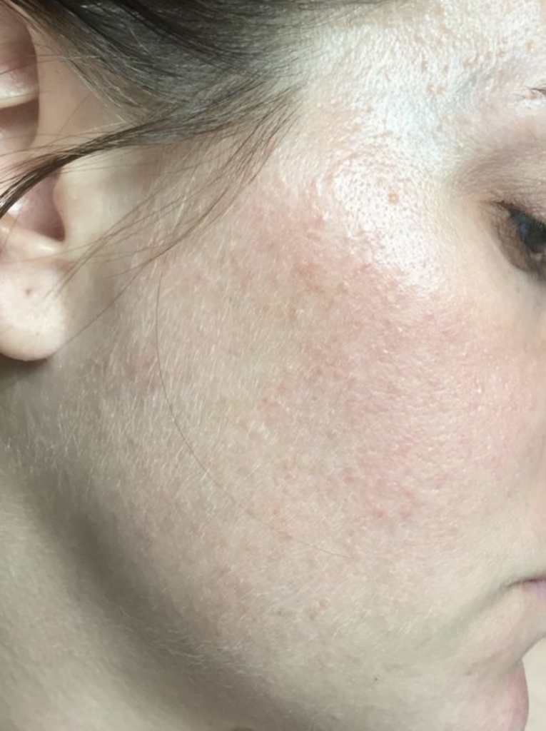 Damaged skin barrier from retinoids
