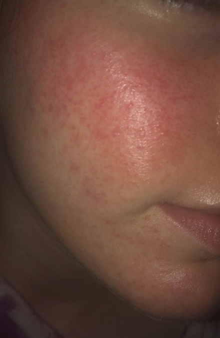 Best retinol for rosacea