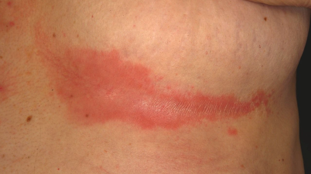 Intertrigo under breast fold