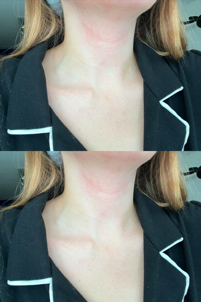 Best Soap for Intertrigo Skin Rash: Causes & Treatment