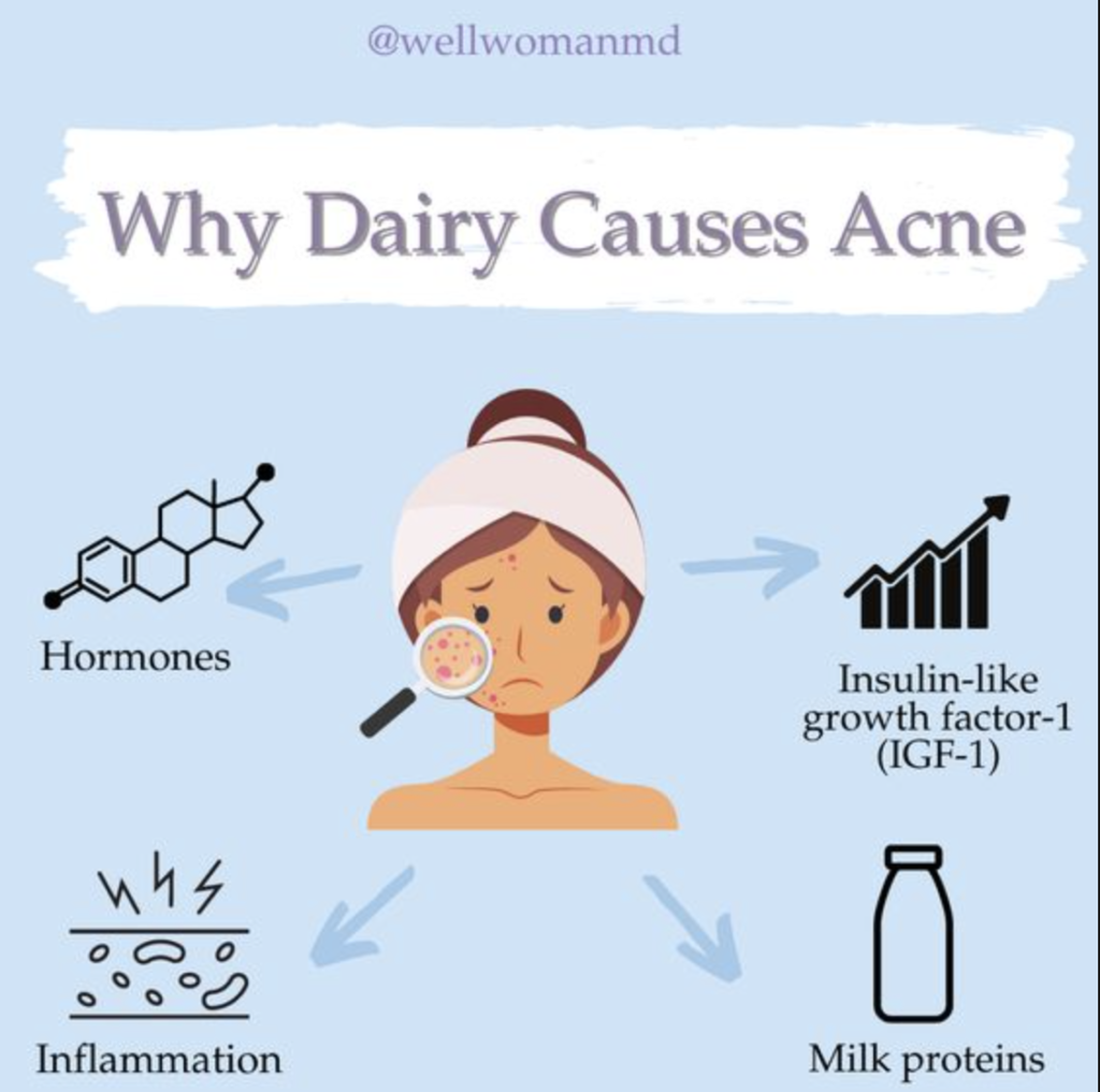 Does dairy cause acne?