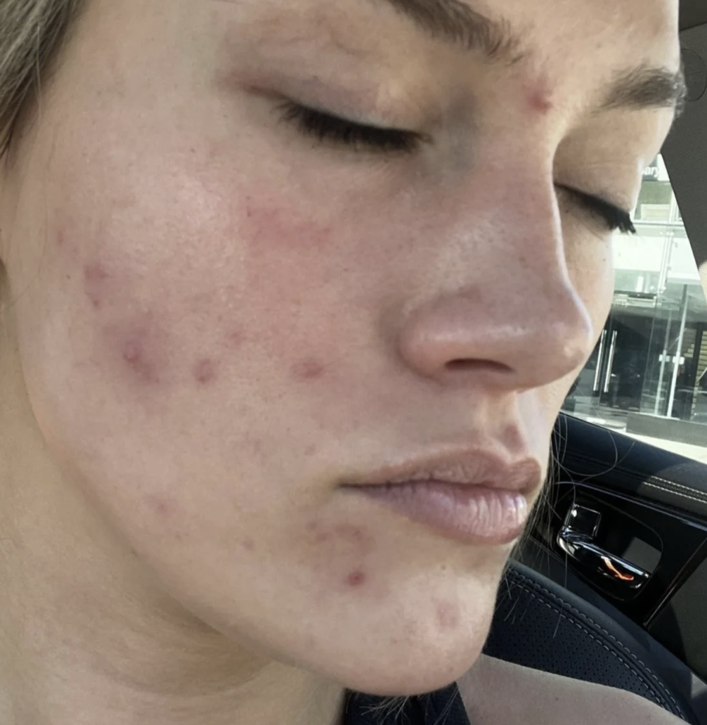 What do breakouts from Celisus look like?