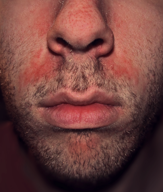 best face wash for seborrheic dermatitis