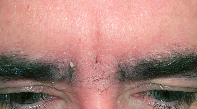 Symptoms of seborrheic dermatitis