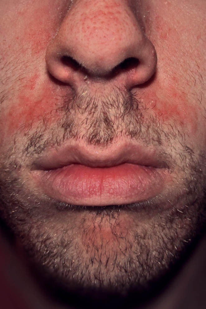 10 Best Face Washes for Seborrheic Dermatitis Treatment