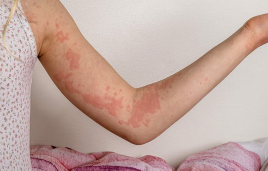 Side effects of using an expired product