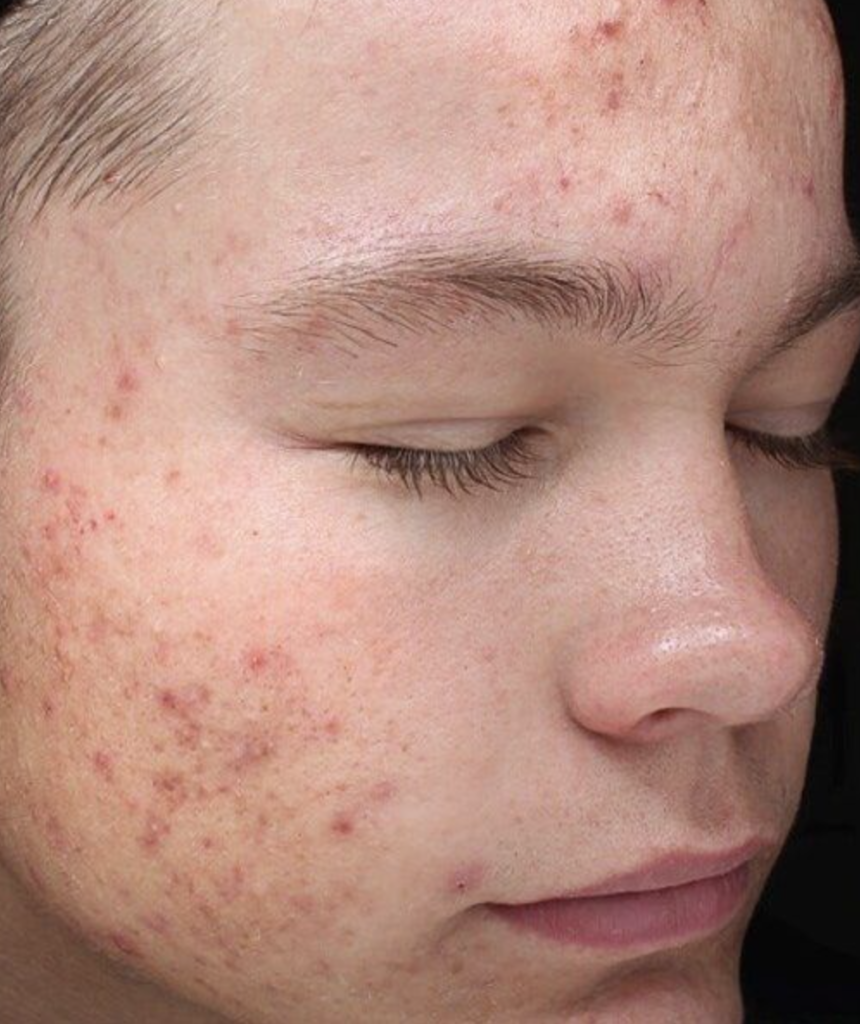 Why a retinoid can cause new acne breakouts