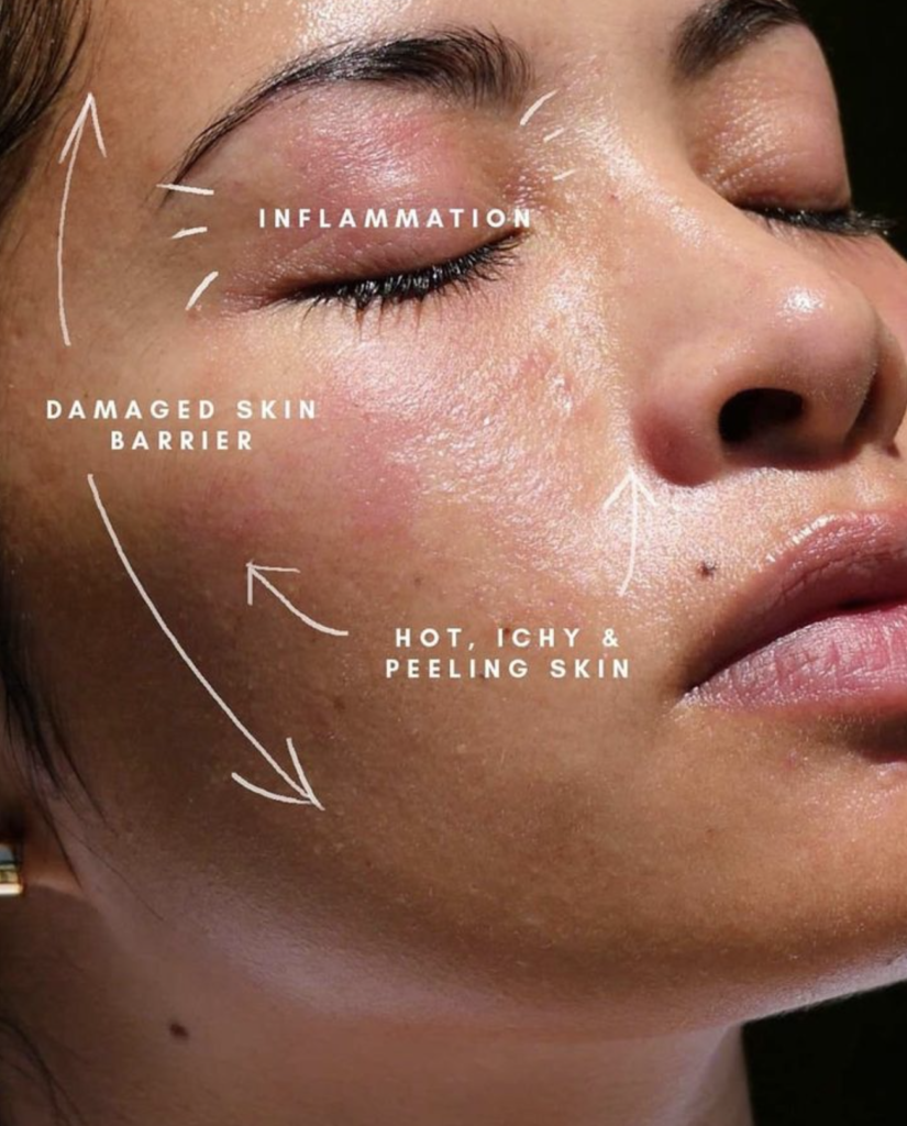 How to repair a damaged skin barrier