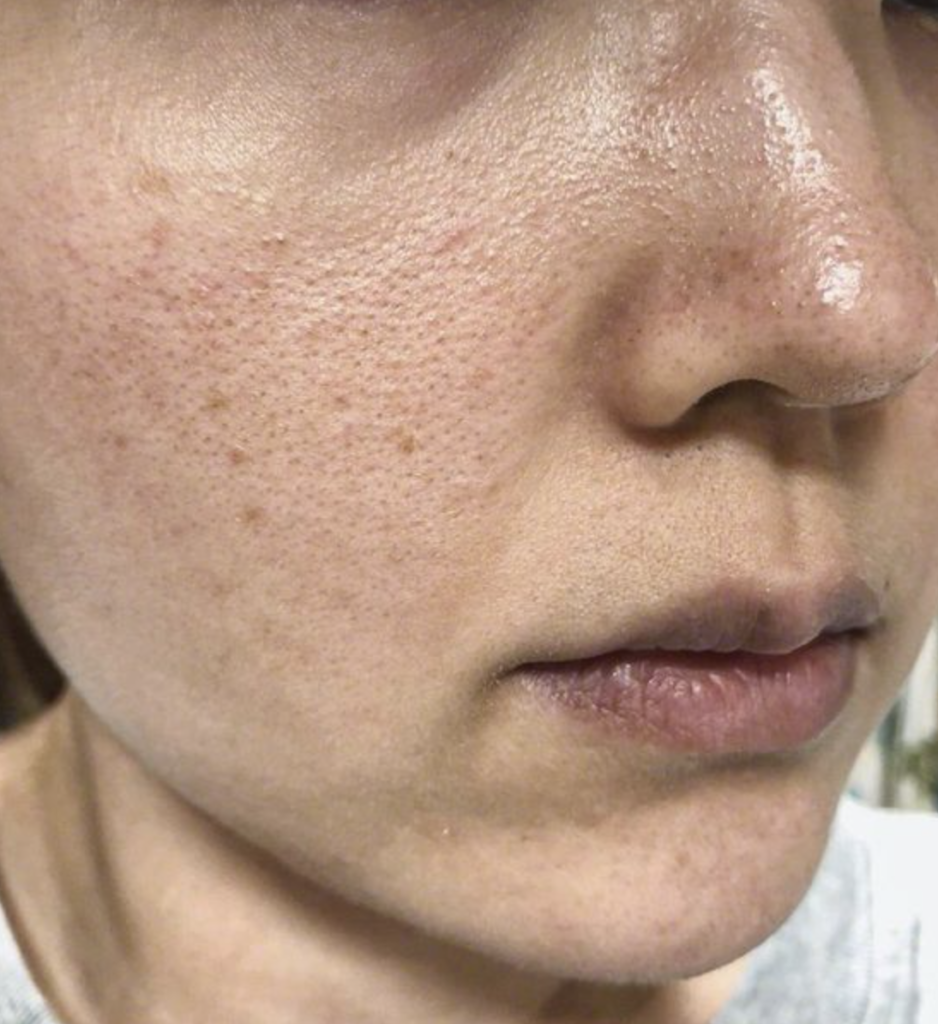How often to use a retinoid
