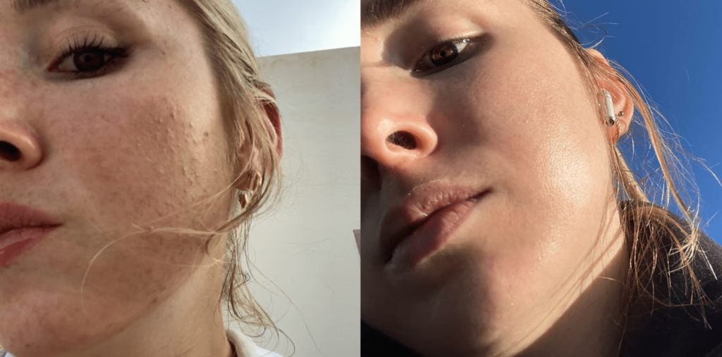 retinal before after