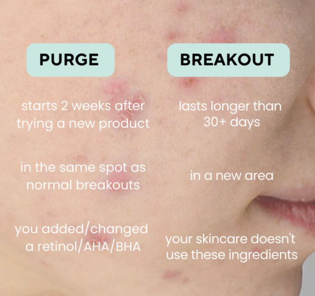 Does the Anua cleanser cause purging?