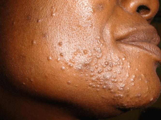 Skin and Me making skin worse
