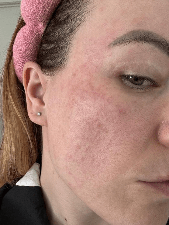 facial cleansing brushes for acne