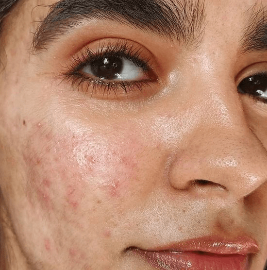 Foreo vs Clarisonic for acne with oily skin