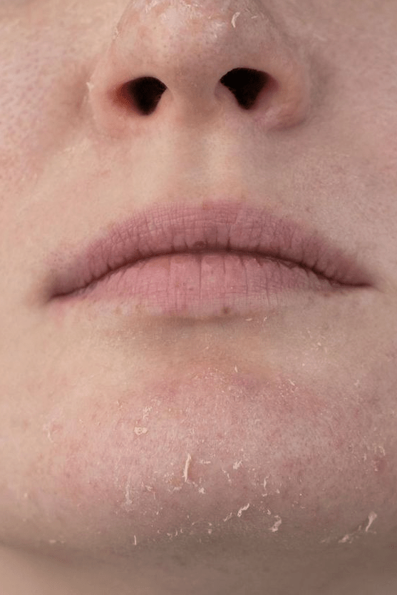 Foreo vs Clarisonic for acne with dry skin