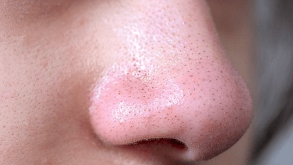 Do facial cleansing brushes remove blackheads?