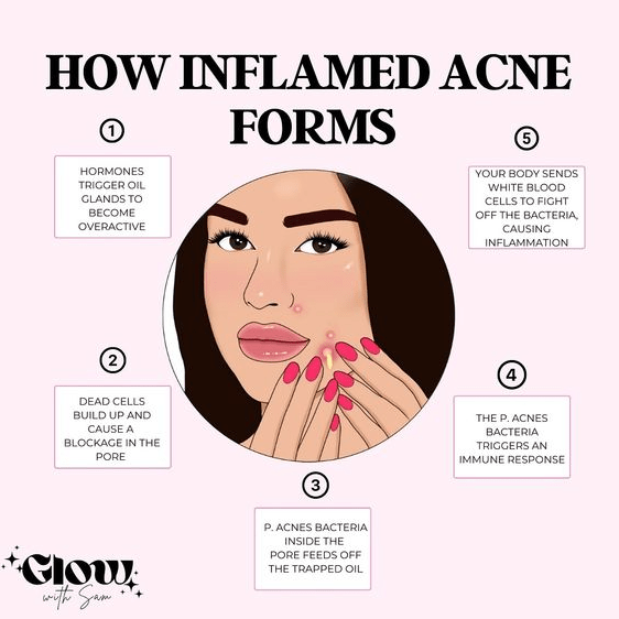 Foreo vs Clarisonic for acne