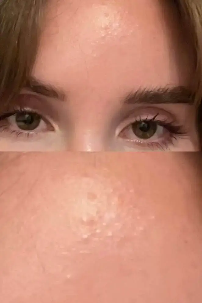16 Best Moisturizers for Fungal Acne and Malassezia