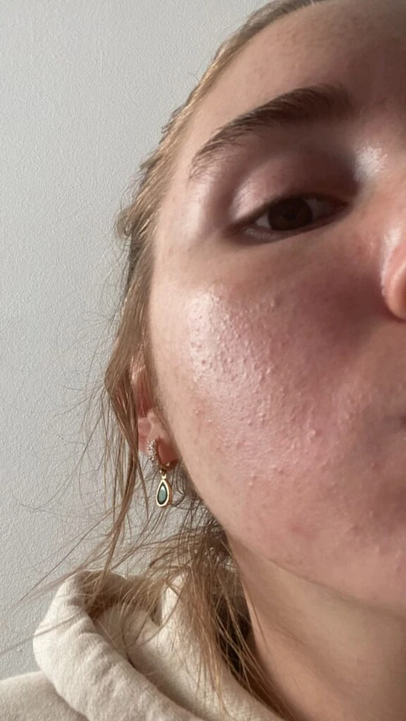 Do I have fungal acne or closed comedones?