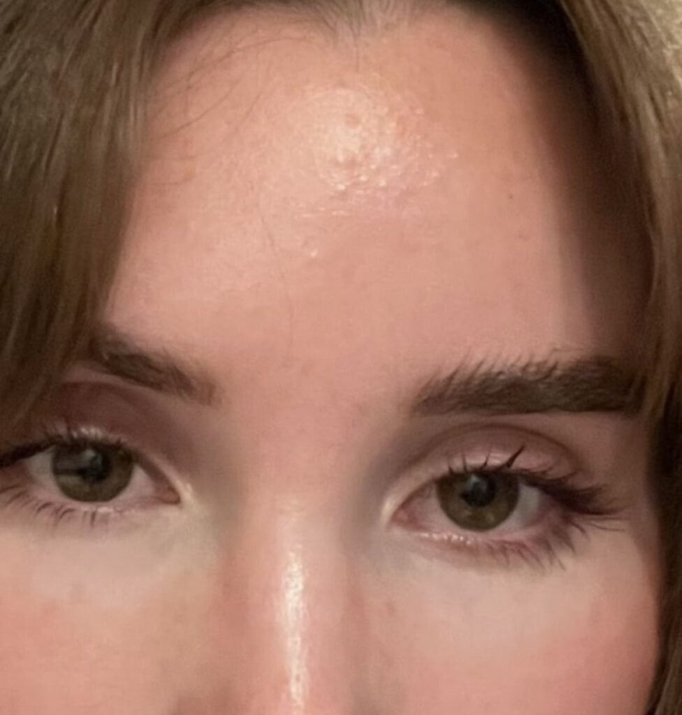 Best moisturizers for fungal acne on a budget