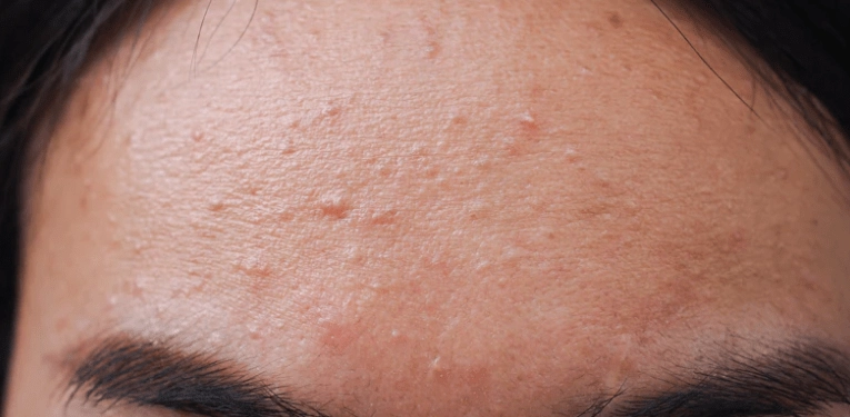 Fungal acne out of nowhere