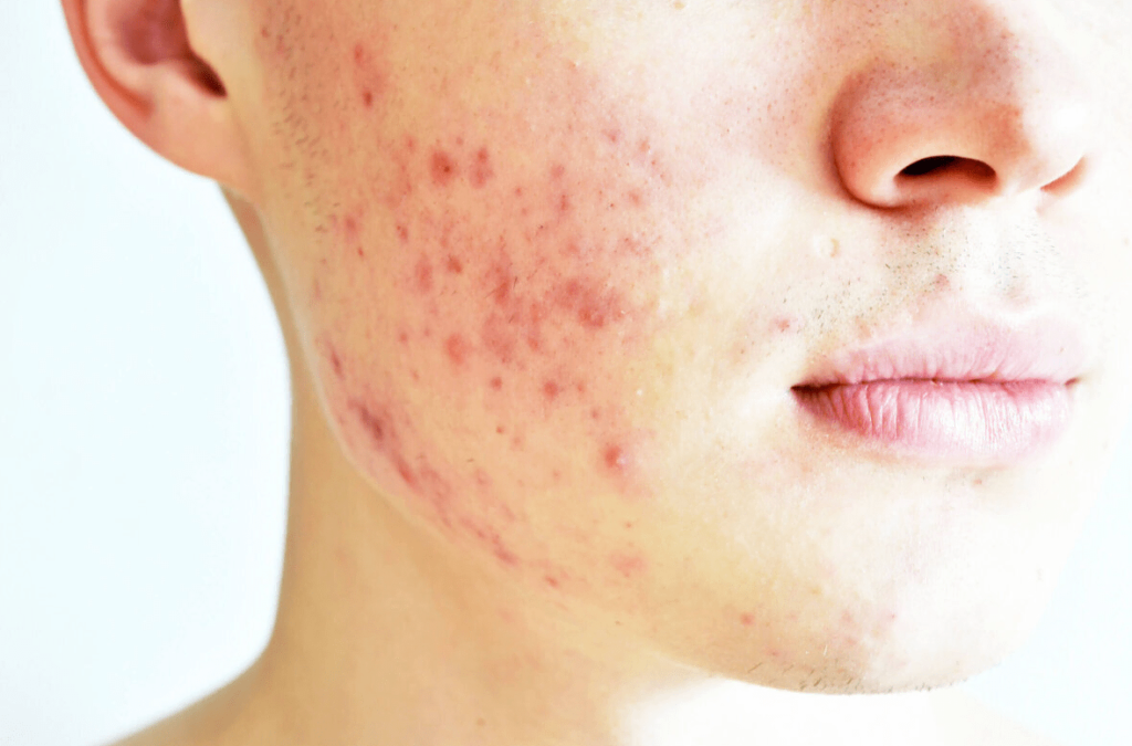 Acne vulgaris vs fungal acne look