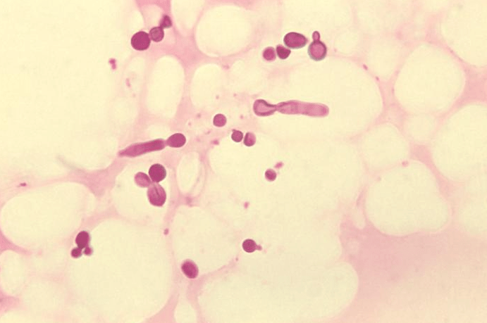 What is fungal acne caused by?