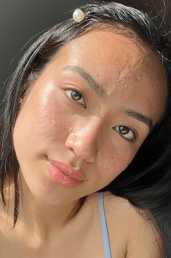 Best Korean skincare for acne: treatments